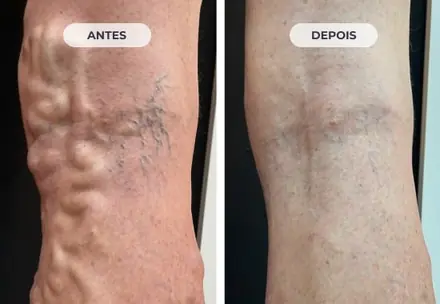 Perna antes e depois do tratamento das varizes com a Técnica ATTA, caso 2 de 6