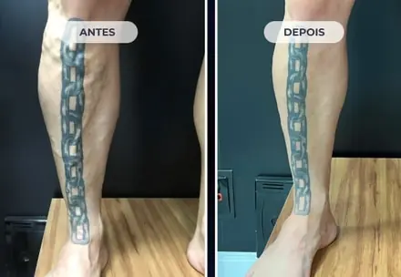 Perna antes e depois do tratamento das varizes com a Técnica ATTA, caso 4 de 6