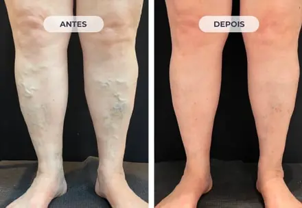 Perna antes e depois do tratamento das varizes com a Técnica ATTA, caso 5 de 6
