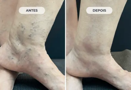 Perna antes e depois do tratamento das varizes com a Técnica ATTA, caso 6 de 6